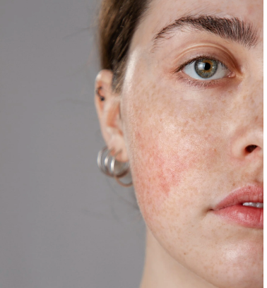 How to Choose the Right Skincare for Sensitive Skin in Women Affected by Stress